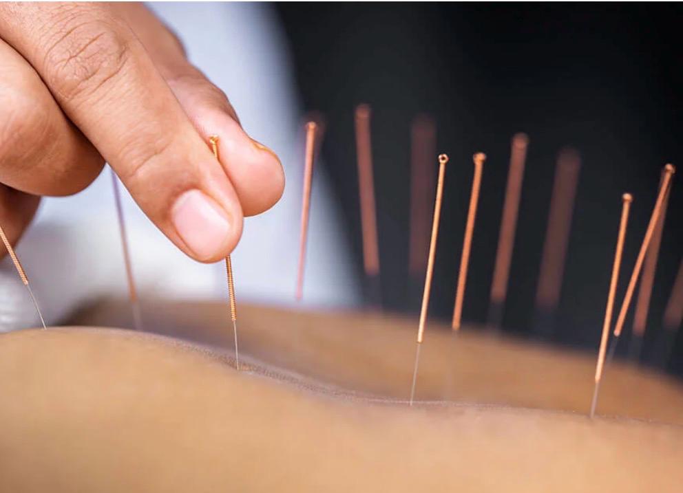 Acupuntura